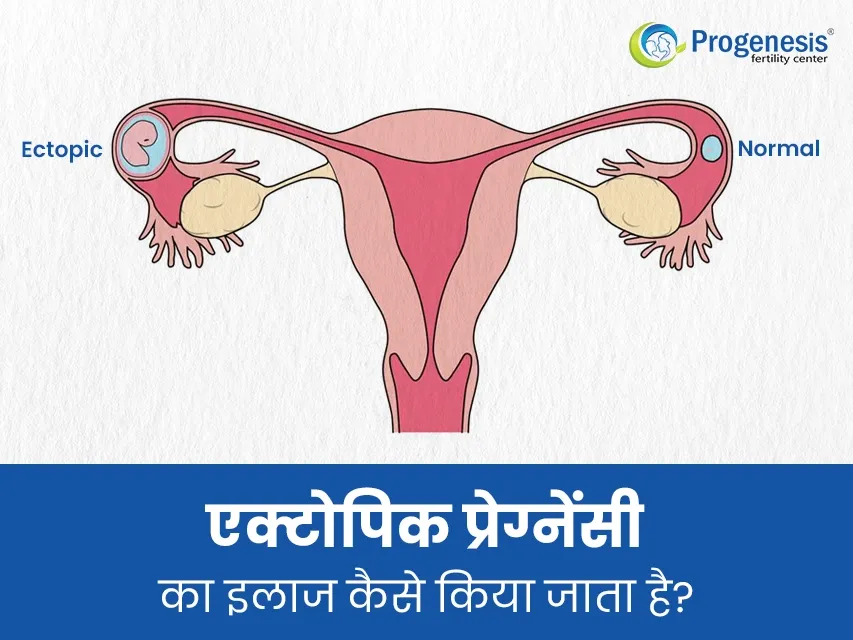 एक्टोपिक प्रेग्नेंसी का इलाज कैसे किया जाता है? जानें पूरी जानकारी